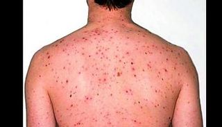 مريض بجدري القرود _ أرشيفية