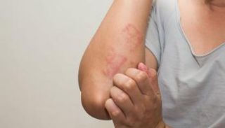 شخص يعاني من أحد أنواع الإكزيما