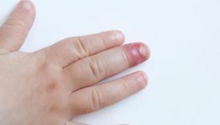 سُمك الظفر وتغير لونه من أعراض التهاب مرقد الظفر