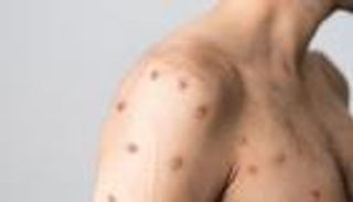 توصية بريطانية بتلقيح "المثليين" ضد جدري القرود.. ما السر؟