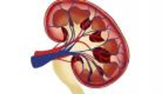 الاستماتة الحديدية تعالج نوعا نادرا من سرطان الكلى.. فما هي؟