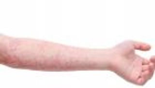 مرض جديد يضرب المثليين في فلوريدا.. أسوأ تفش في تاريخ أمريكا