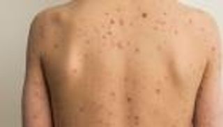 جدري القرود.. منظمة الصحة تعلن إجمالي المصابين حول العالم