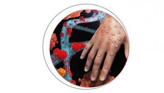 جدري القرود لم يصل إلى حالة الطوارئ الصحية العالمية