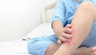 الحمى القرمزية تندرج ضمن الأمراض الشائعة لدى الأطفال - أرشيفية