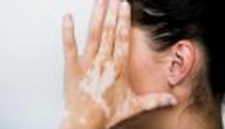 هل يتسبب كورونا في زيادة مرضى البهاق؟.. هاني الناظر يجيب