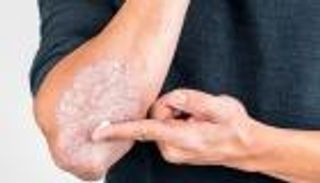 انخفاض نسبة إصابة النساء بالصدفية.. السر في هذا الهرمون