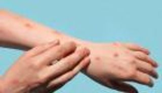 يهدد الفئات الأضعف.. تحذير أممي من خطورة جدري القرود