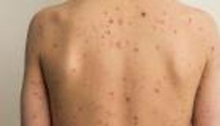 أول إصابة بجدري القرود في تركيا