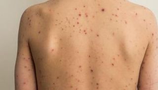 رجل مصاب بجدري القرود - أرشيفية