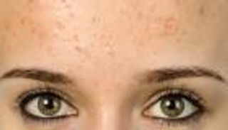 أسباب حبوب الجبهة وأنواعها.. 3 طرق طبيعية للعلاج