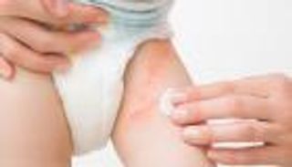 التهاب الجلد الحفاضي.. الأسباب والعلاج