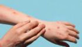 2000 إصابة بجدري القرود في ألمانيا