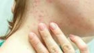 جدري القرود يغزو 69 دولة.. هل يصبح مرضا متوطنا؟