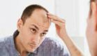 بتنشيط خلايا بصيلات الشعر الجذعية.. علاج محتمل للصلع