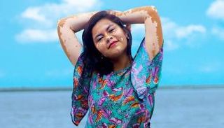 معاناة مرضى البهاق تزداد في الصيف