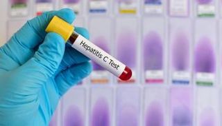 يعيش 354 مليون شخص في العالم مع التهاب الكبد B أو C