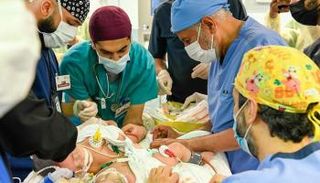 بدء عملية فصل التوأم السيامي اليمني "مودة ورحمة"