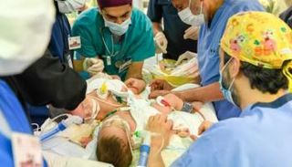 عملية فصل التوأم