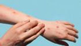 أول وفاة بجدري القرود في إسبانيا