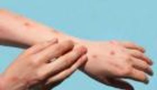 جدري القرود في إسبانيا.. الإبلاغ عن ثاني وفاة