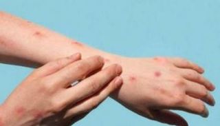 مريض بجدري القرود- أرشيفية