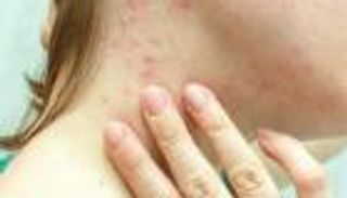 البرازيل تسجل أول وفاة بجدري القرود