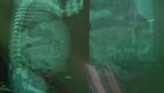 تحمل جنينا في بطنها.. طبيب الطفلة المصرية يكشف لـ"العين الإخبارية" تطورات الحالة