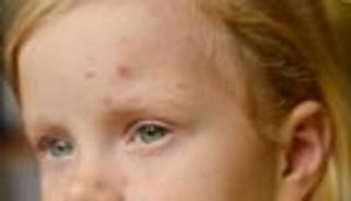 جدري القرود يصيب الأطفال أيضا.. ما يجب أن يعرفه الآباء