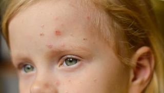 طفل مصاب بأعراض جدري القرود