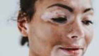 دواء جديد للبهاق.. هاني الناظر يوضح طبيعته وسعره لـ"العين الإخبارية"