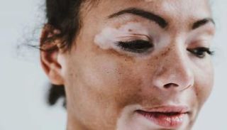 أعراض مرض البهاق- تعبيرية