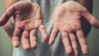 جدري القرود.. أول إصابتين بين مراهقين في ألمانيا