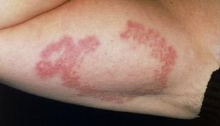 مريض سكري مصاب بمشاكل جلدية- أرشيفية