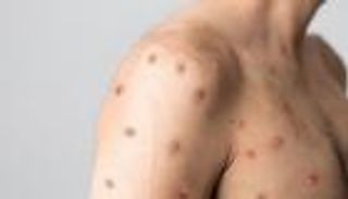 أمريكا تعلن "طوارئ صحية" لمواجهة تفشي جدري القرود