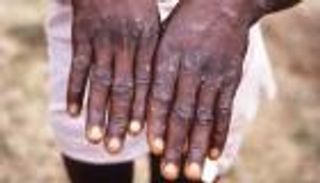 إيطاليا تبدأ حملة للتطعيم ضد جدري القرود