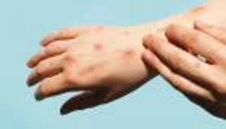 جدري القرود.. أحدث دراسة تكشف عن عرضين جديدين