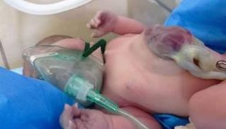 ولادة طفلة بقلب خارج القفص الصدري بالعراق