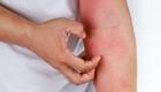 "الصحة المصرية" تحذر من أمراض تصيب الجلد خلال الصيف