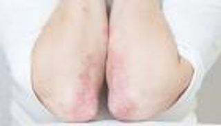 9 علامات تحدث قبل آلام التهاب المفاصل الصدفي.. انتبه لـ"أصابع السجق"