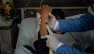 جدري القرود ينتشر في بيرو.. 92% من المصابين "مثليون"