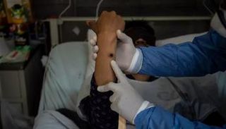 مصاب بجدري القرود في بيرو