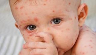 حالة الرضيع المصاب مستقرة وغير مقلقة