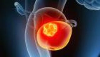 سرطان المثانة.. أعراض تدق ناقوس الخطر