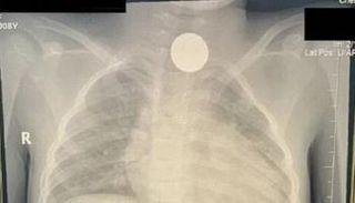 الأشعة تظهر العملة المعدنية العالقة بمريء الطفلة