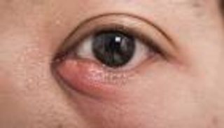 الأكياس الدمعية.. أسباب عدة أبرزها الخمر والتدخين