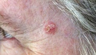 التقرن السفعي يصيب المناطق المعرضة للشمس- أرشيفية