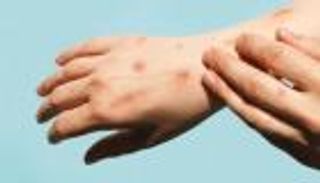 أمريكا تسجل أول حالة وفاة بفيروس جدري القرود في تكساس