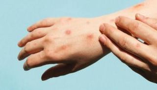 شخص تظهر عليه أعراض جدري القرود - أرشيفية