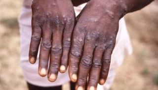 جدري القرود - أرشيفية